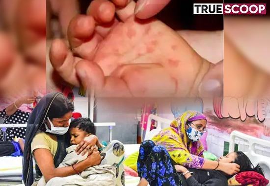 Tomato Flu in Kerala: What is this new Flu, How it is affecting kids, symptoms & prevention tips