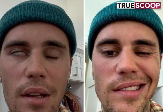 Justin Bieber, right side of face paralyzed, Ramsay Hunt Syndrome, watch video, paralyzed, Instagram, pop singer,- True Scoop