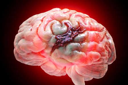 What is Brain Hemorrhage? Causes, Symptoms, and Cure; All you need to know