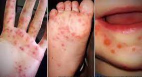 Hand-Foot-Mouth-Viral HFM-disease hand-rashes