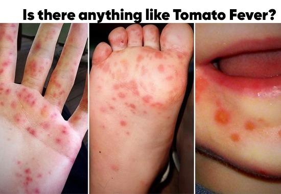Is Tomato Fever same as Hand Foot and Mouth Disease? See what experts have to say 